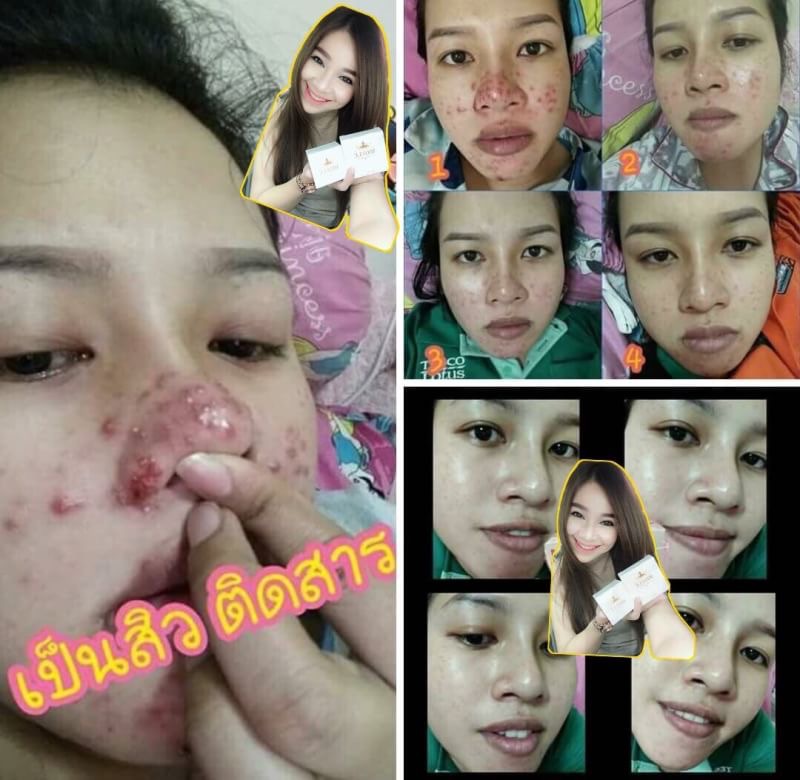 ยารักษาสิว อันตรายใก้ลตัว
